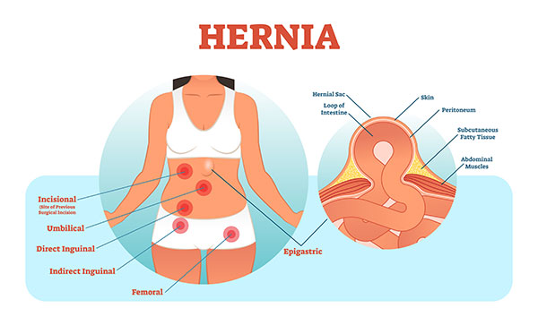 Umbilical Hernia Surgery Melbourne, Paraumbilical Hernia Repair Melbourne,  Victoria