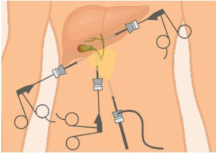 keyhole with four small incisions